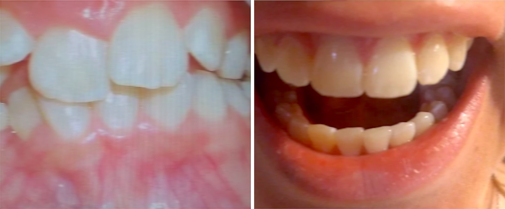 Ortodonzia, prima e dopo: denti affollati riallineati