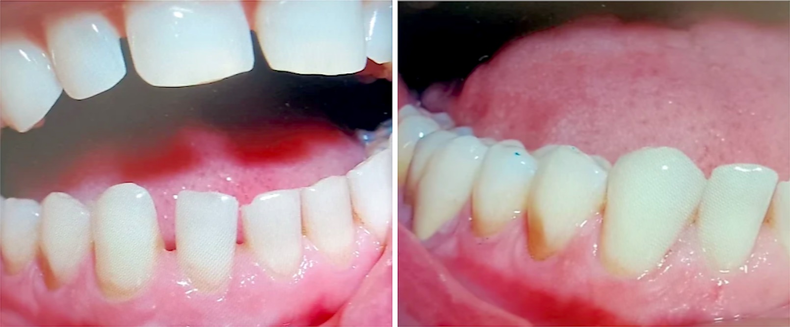 Ricostruzione estetica, prima e dopo: chiusura degli spazi tra i denti inferiori