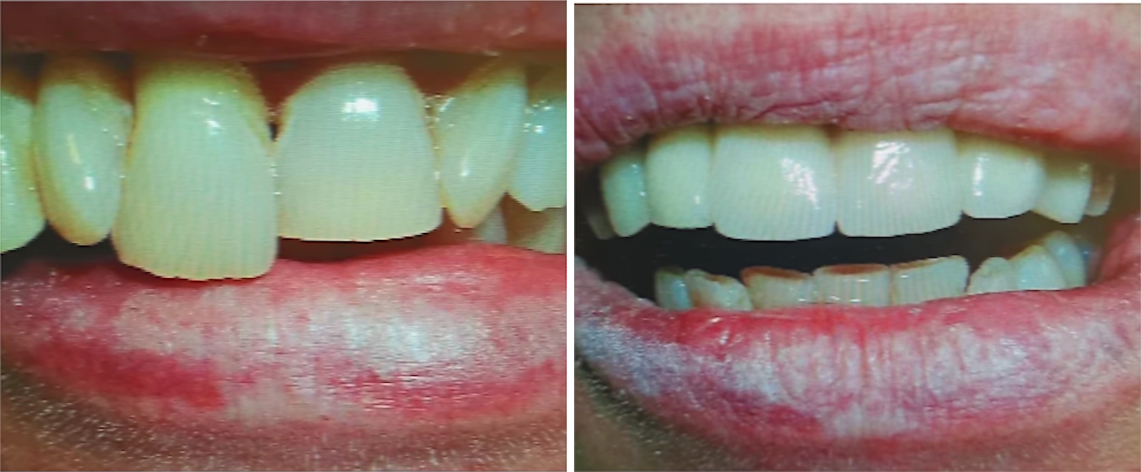 Capsule in ceramica, prima e dopo: denti anteriori rinnovati