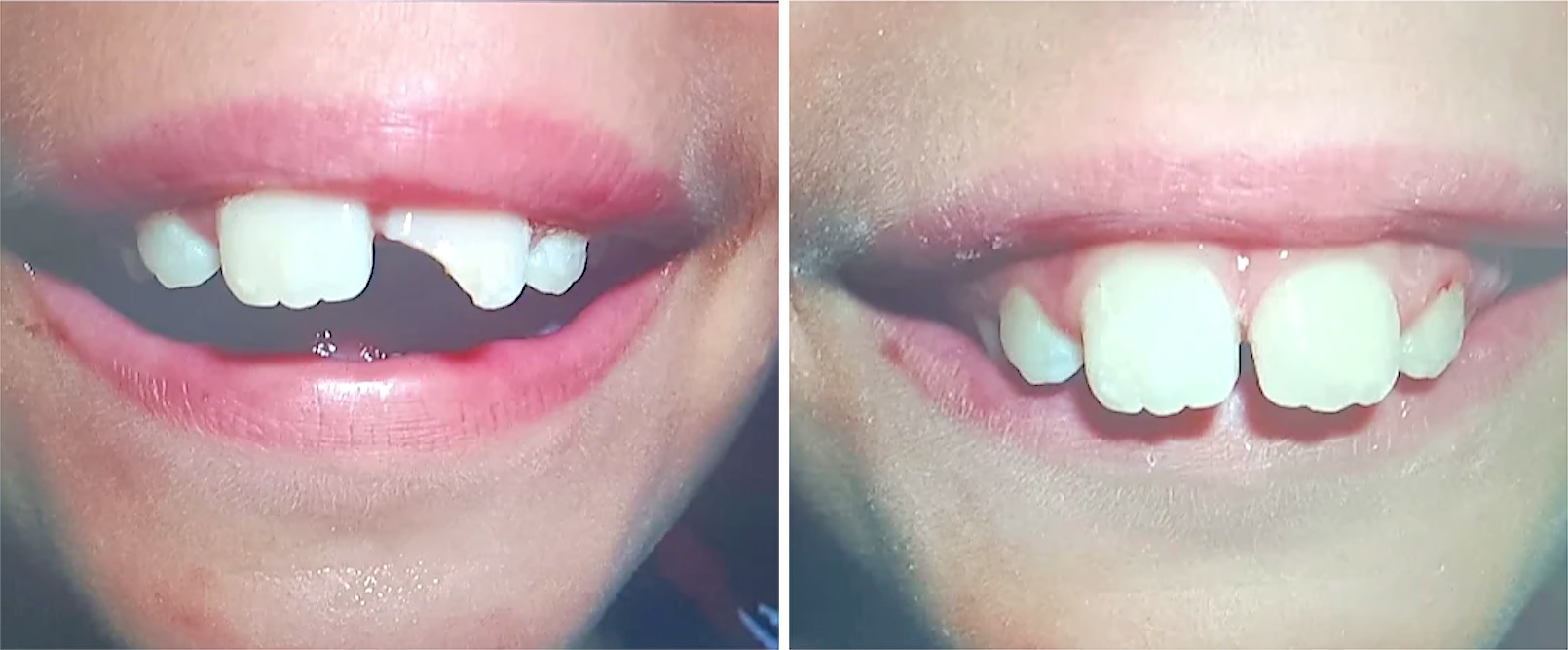 Ricostruzione, prima e dopo: denti anteriori fratturati ricostruiti
