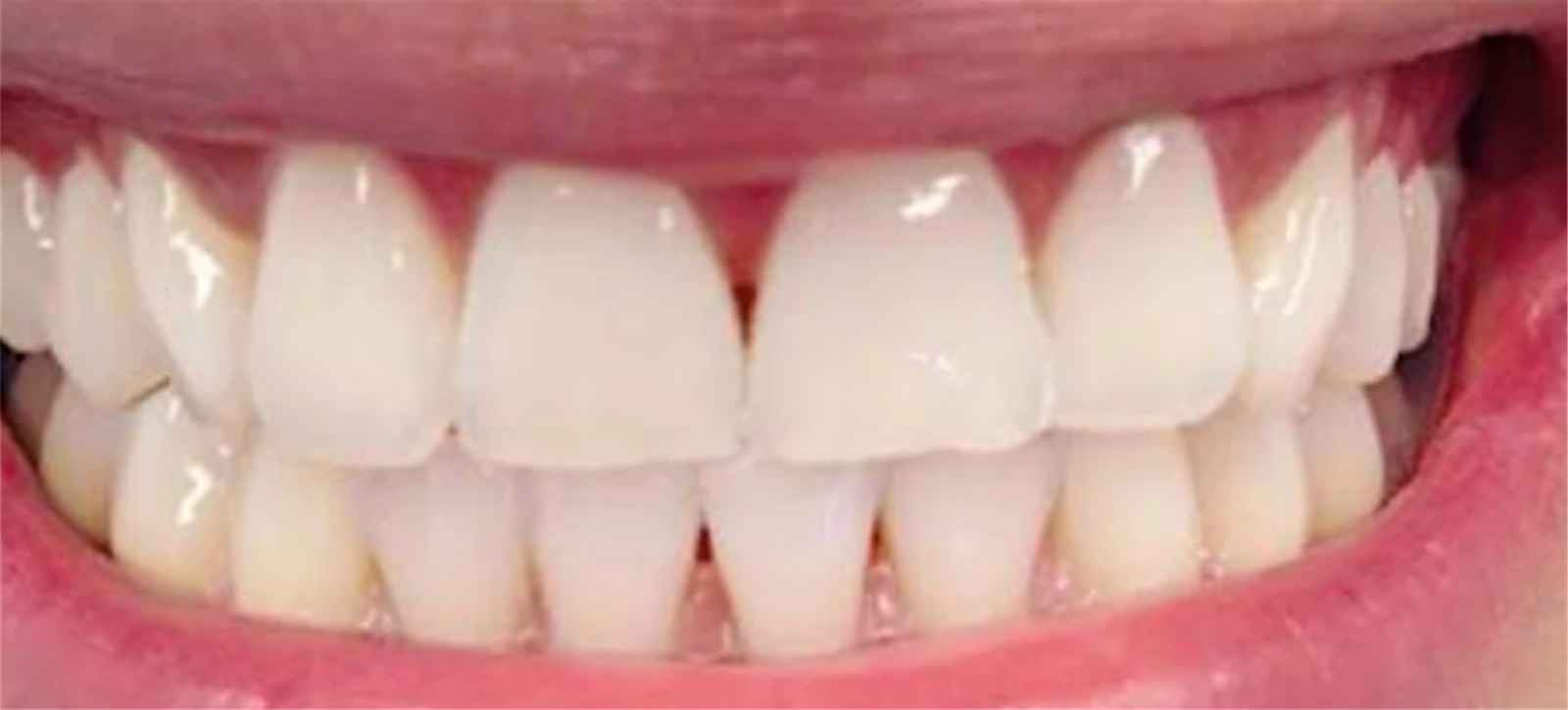 Sorriso dopo lo sbiancamento: denti bianchi e luminosi